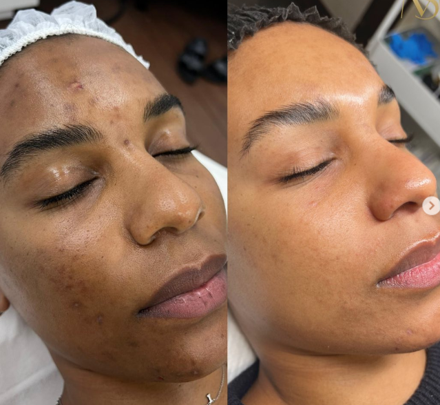 Before and after 4 sessions of Skin Needling — amazing results...